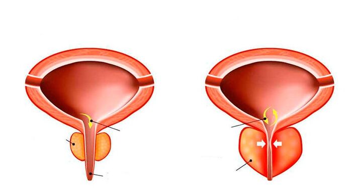 Prostata normale e infiammata