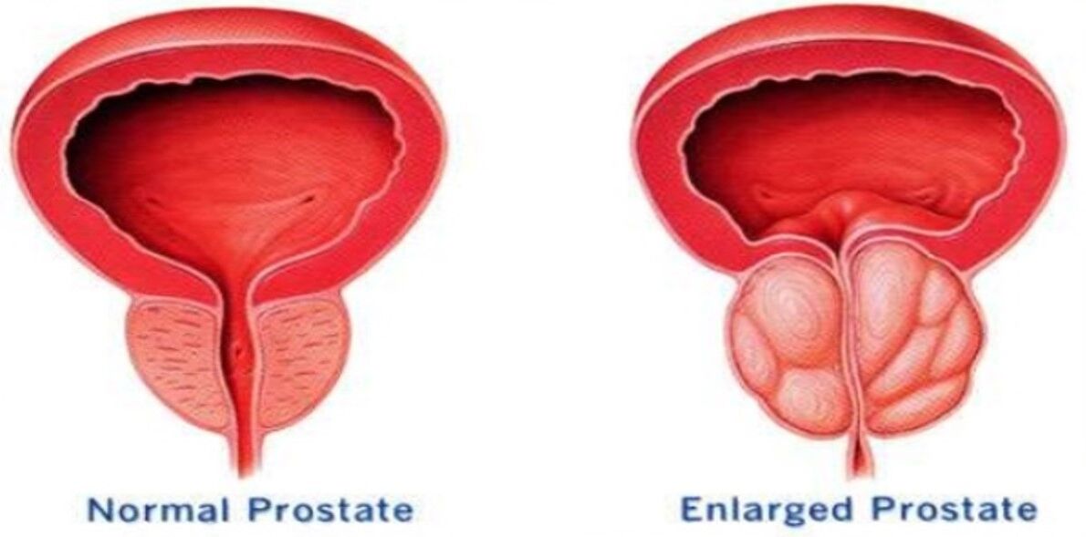 Prostata normale, prostata infiammata